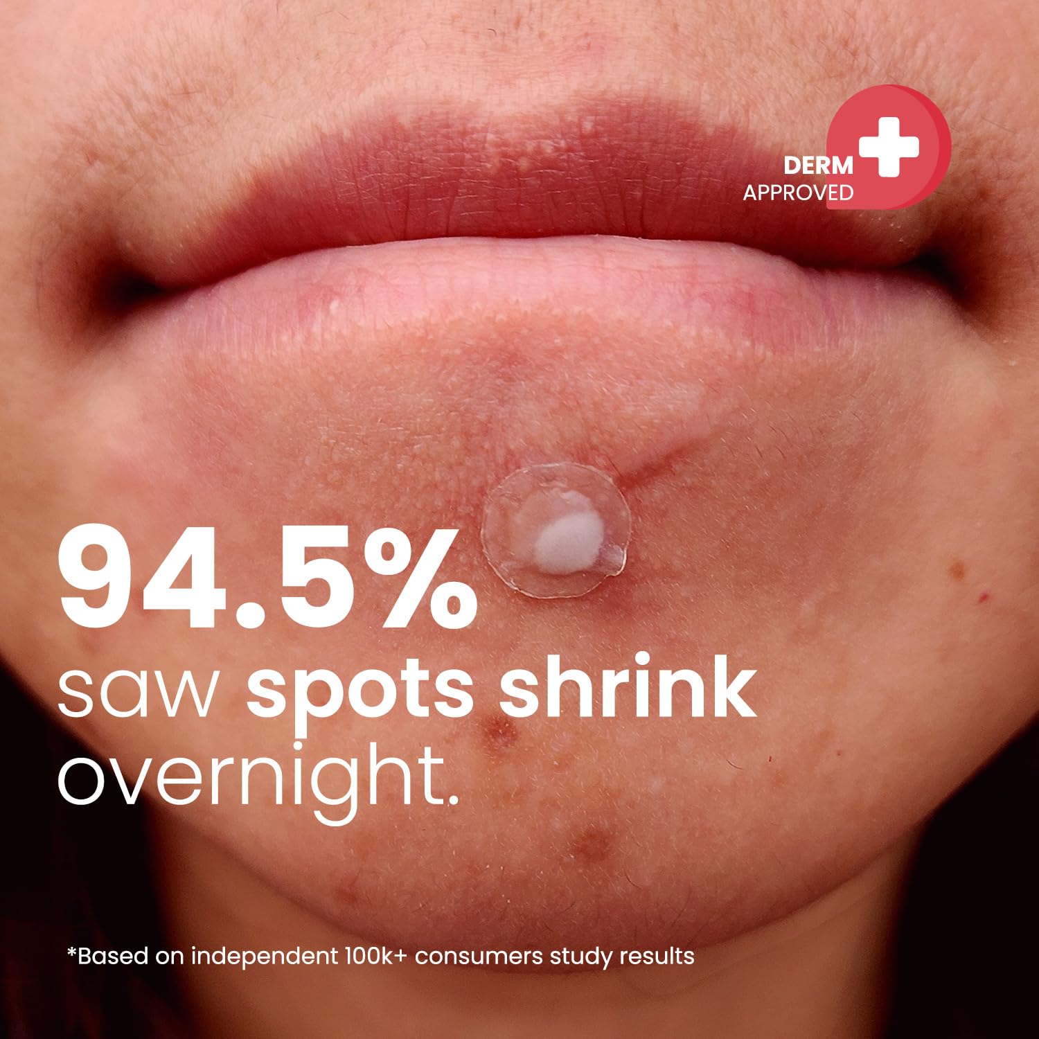 Translucent matte hydrocolloid sticker applied to a facial blemish demonstrating seamless skin blending