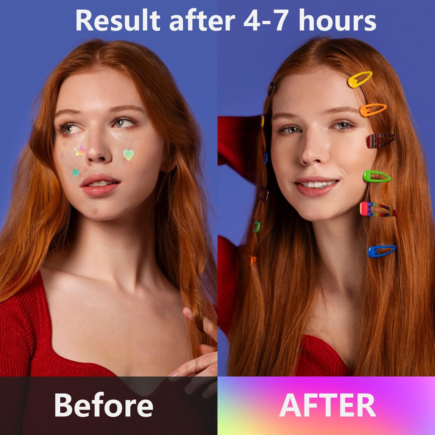 Close-up of acne spot stickers formulated with salicylic acid and centella asiatica for blemish care