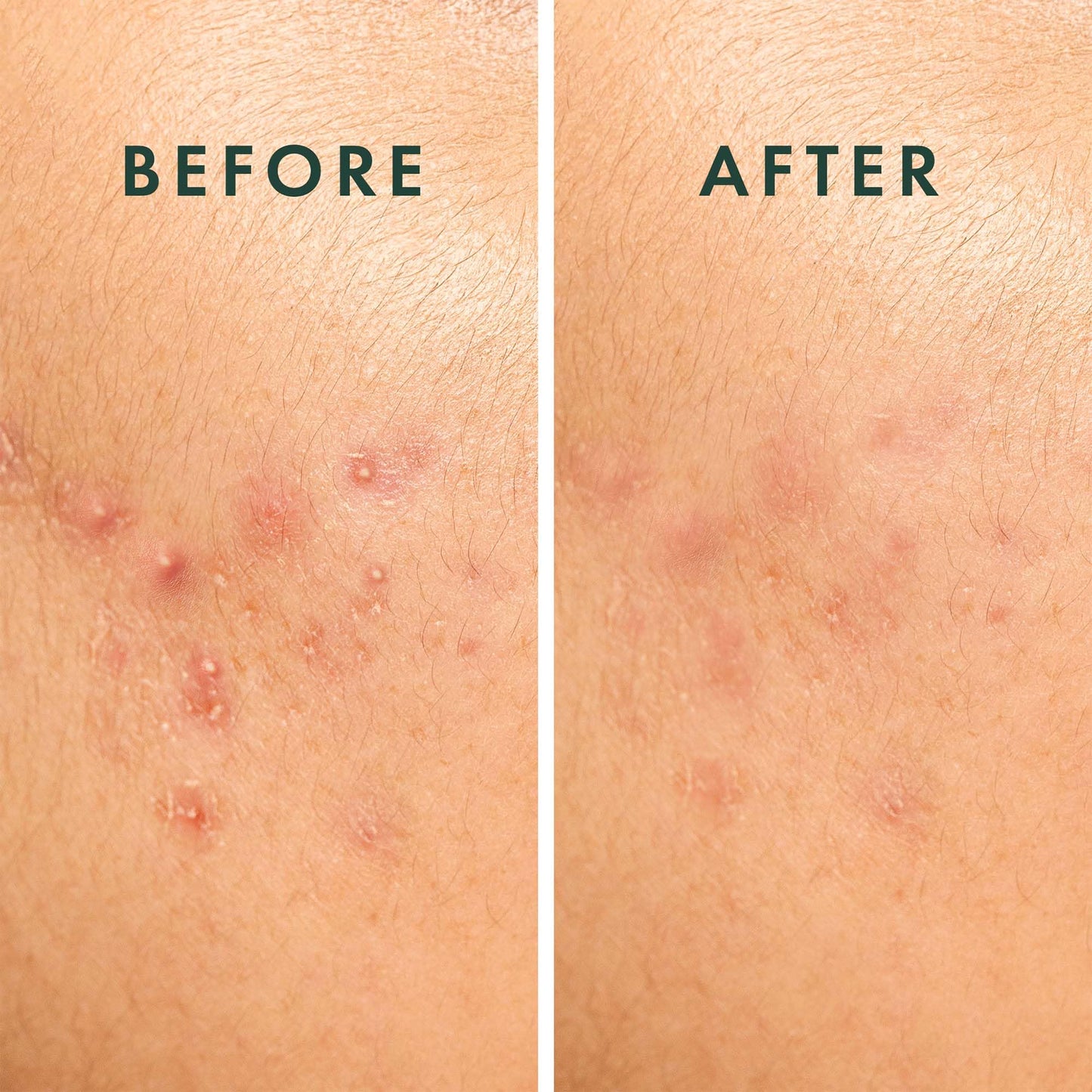 Hypoallergenic and drug free large acne spot covers showing transparent material texture