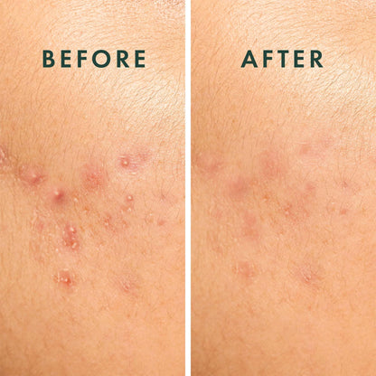 Hypoallergenic and drug free large acne spot covers showing transparent material texture