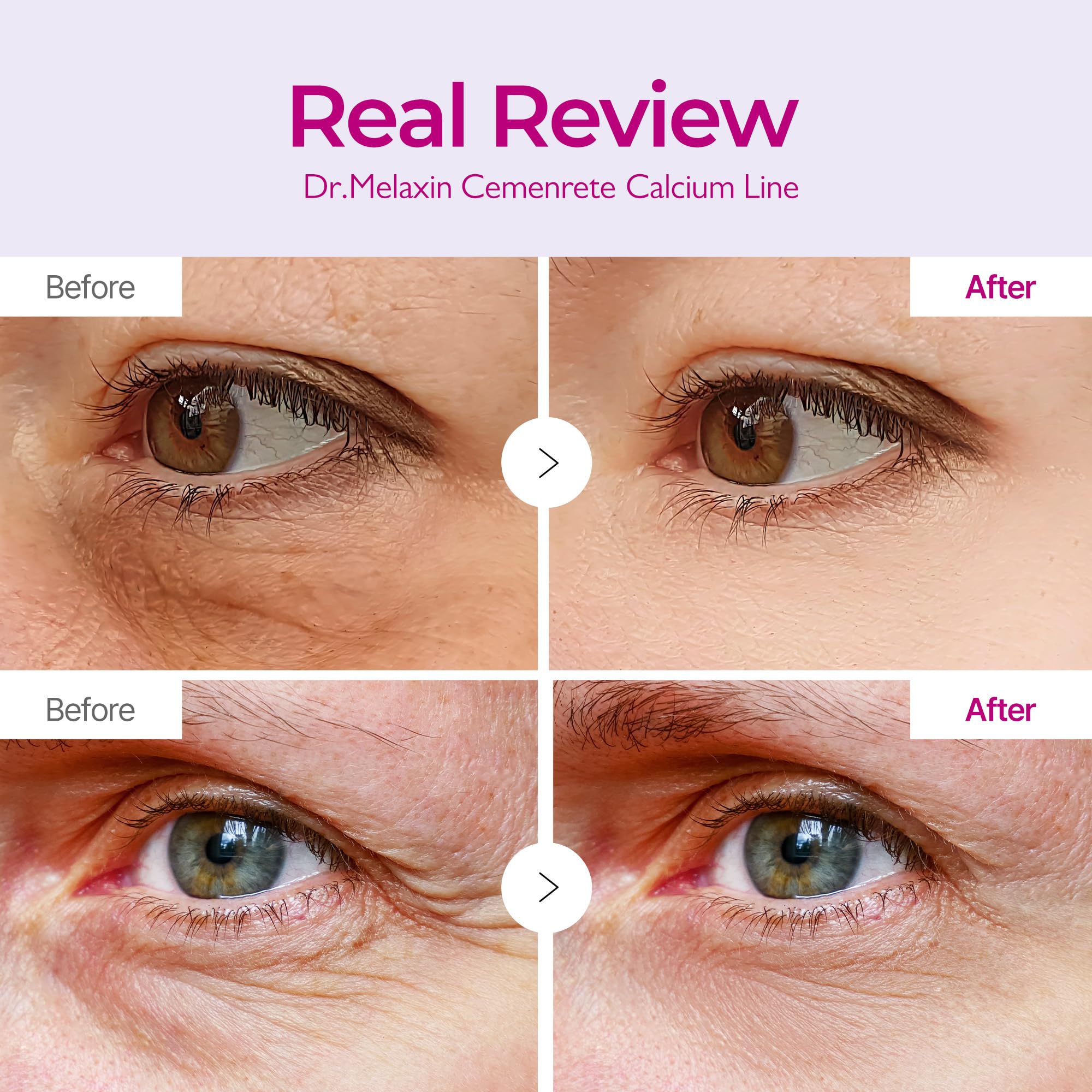 Close up of an embossed hydrogel patch being applied to the under eye area