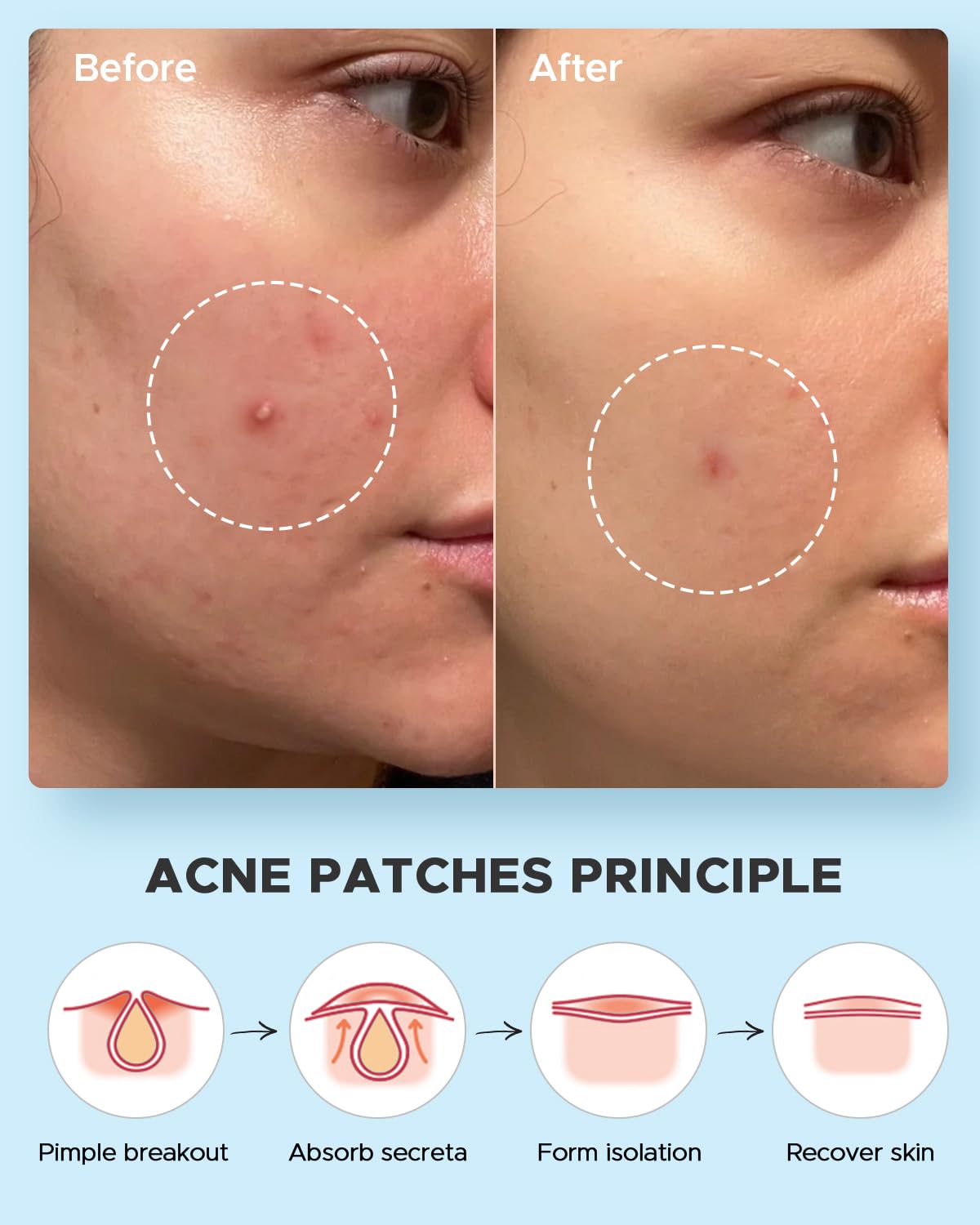 Assorted sheet of 180 LitBear pimple patches showcasing thin and thick transparent acne stickers