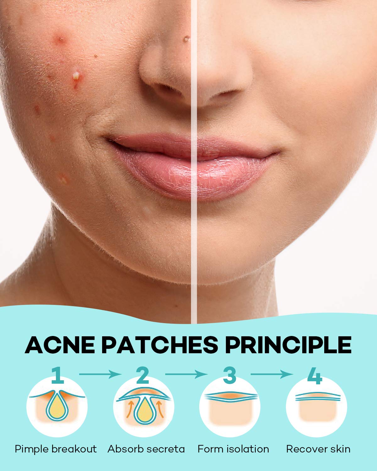 TKTK pimple patch before and after comparison showing impurity absorption from a whitehead.