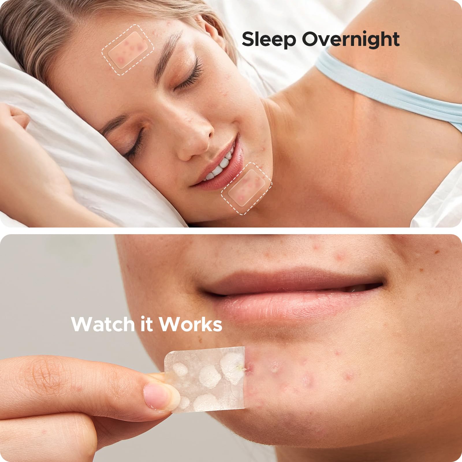 Hydrocolloid strip patch for body acne application