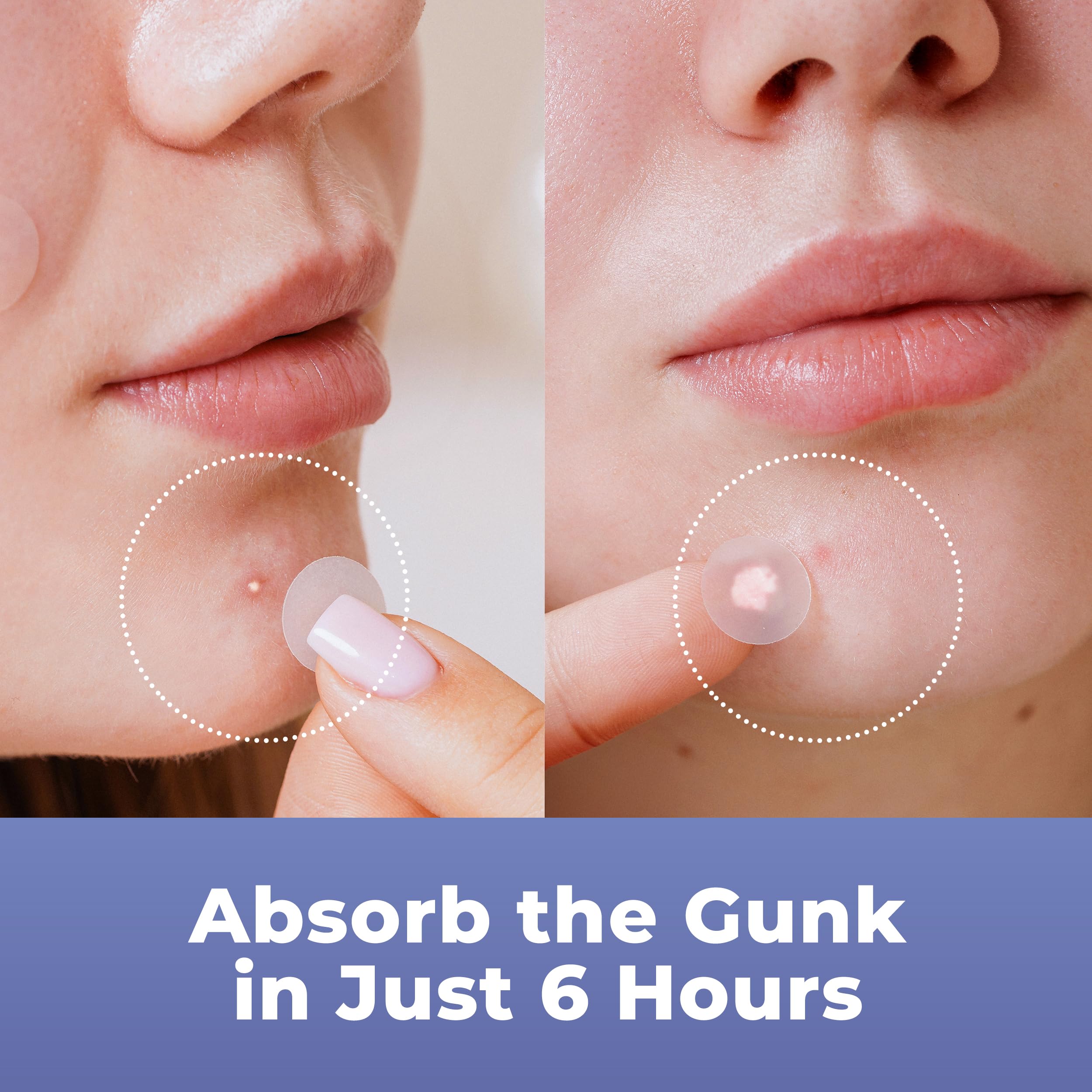 Before and after demonstration of the pimple patch reduction on facial skin blemishes