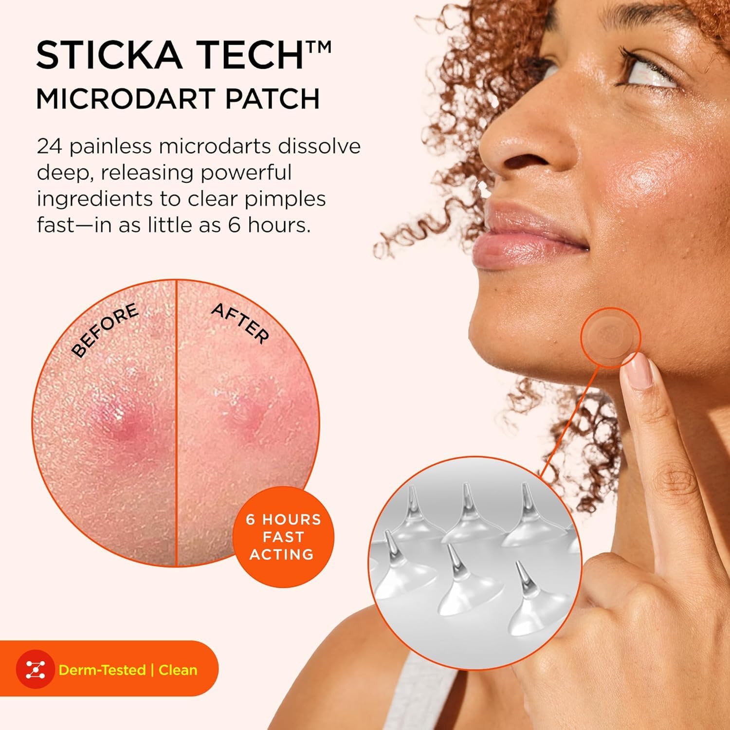 ZitSticka Killa acne patches close up displaying the self dissolving microdart technology