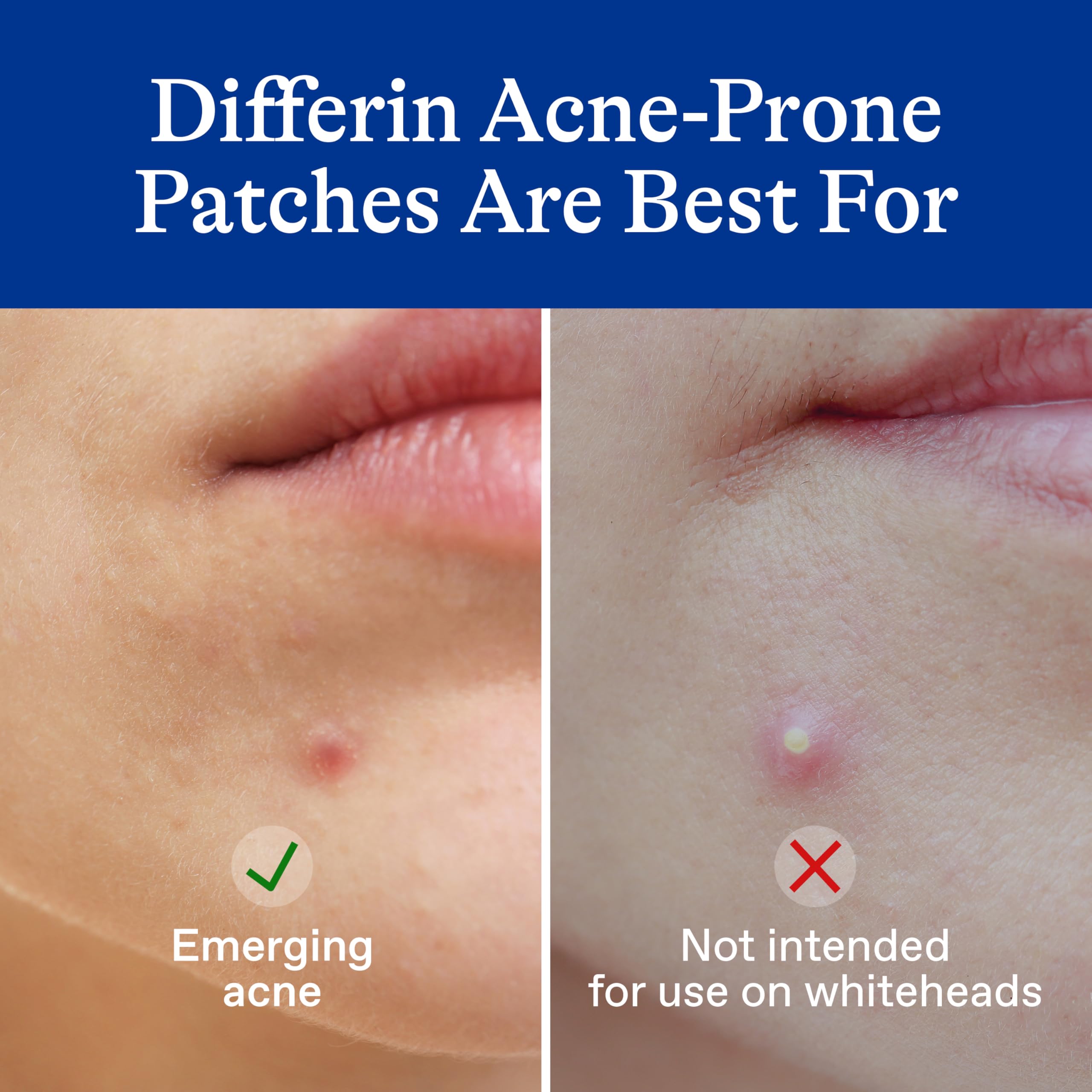 Clear salicylic acid pimple patches in two different sizes for early stage acne