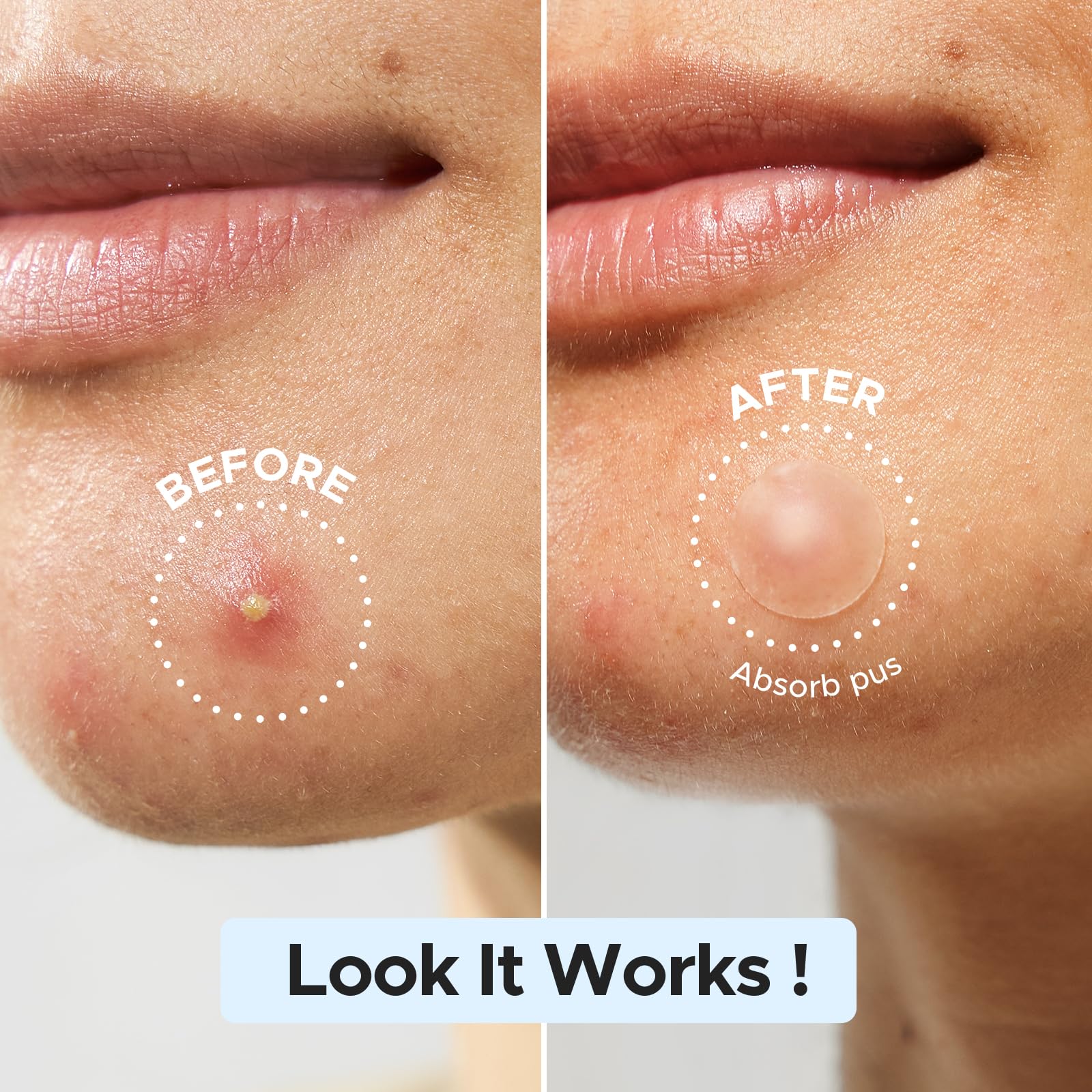 LitBear matte pimple patches applied on the face illustrating its discreet look on the skin.