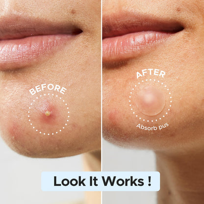 LitBear matte pimple patches applied on the face illustrating its discreet look on the skin.