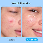 Close-up of clear hydrocolloid patches on skin