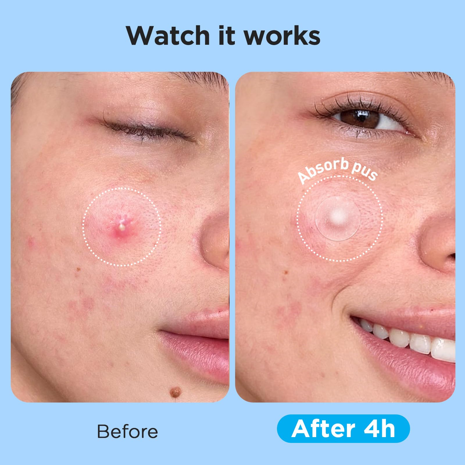 Glowpatch acne patch sheets showcasing different clear sticker dimensions