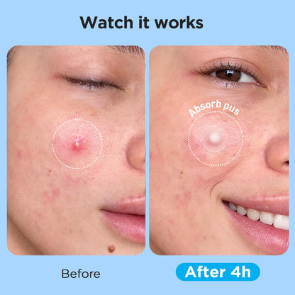 Glowpatch acne patch sheets showcasing different clear sticker dimensions