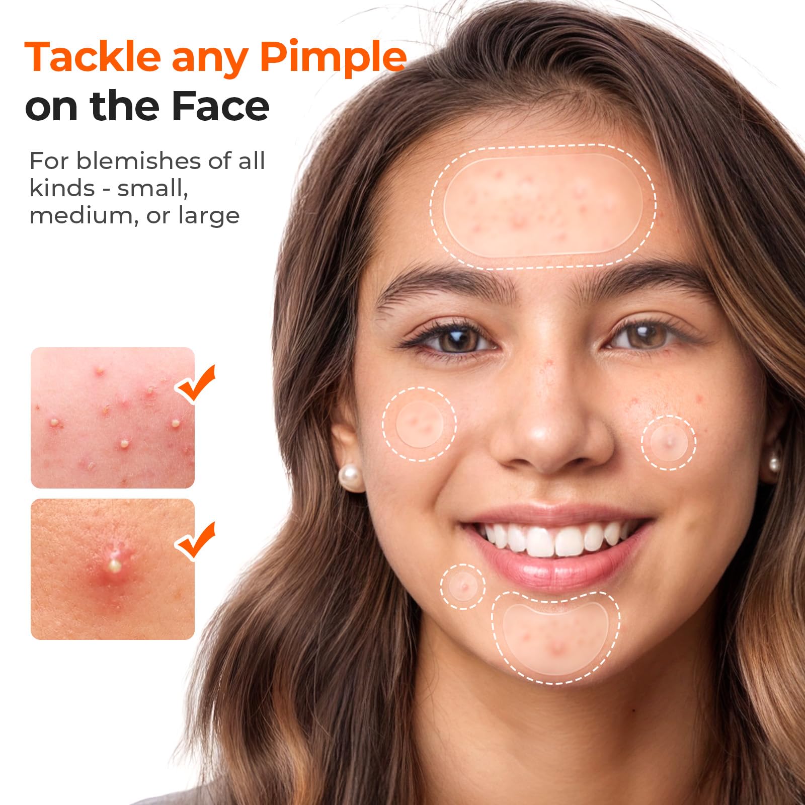 Close-up of a transparent TKTK hydrocolloid pimple patch applied discreetly on the cheek.