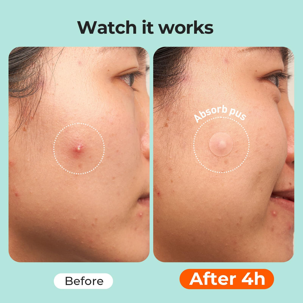 Fragrance-free acne patches applied on forehead and chin