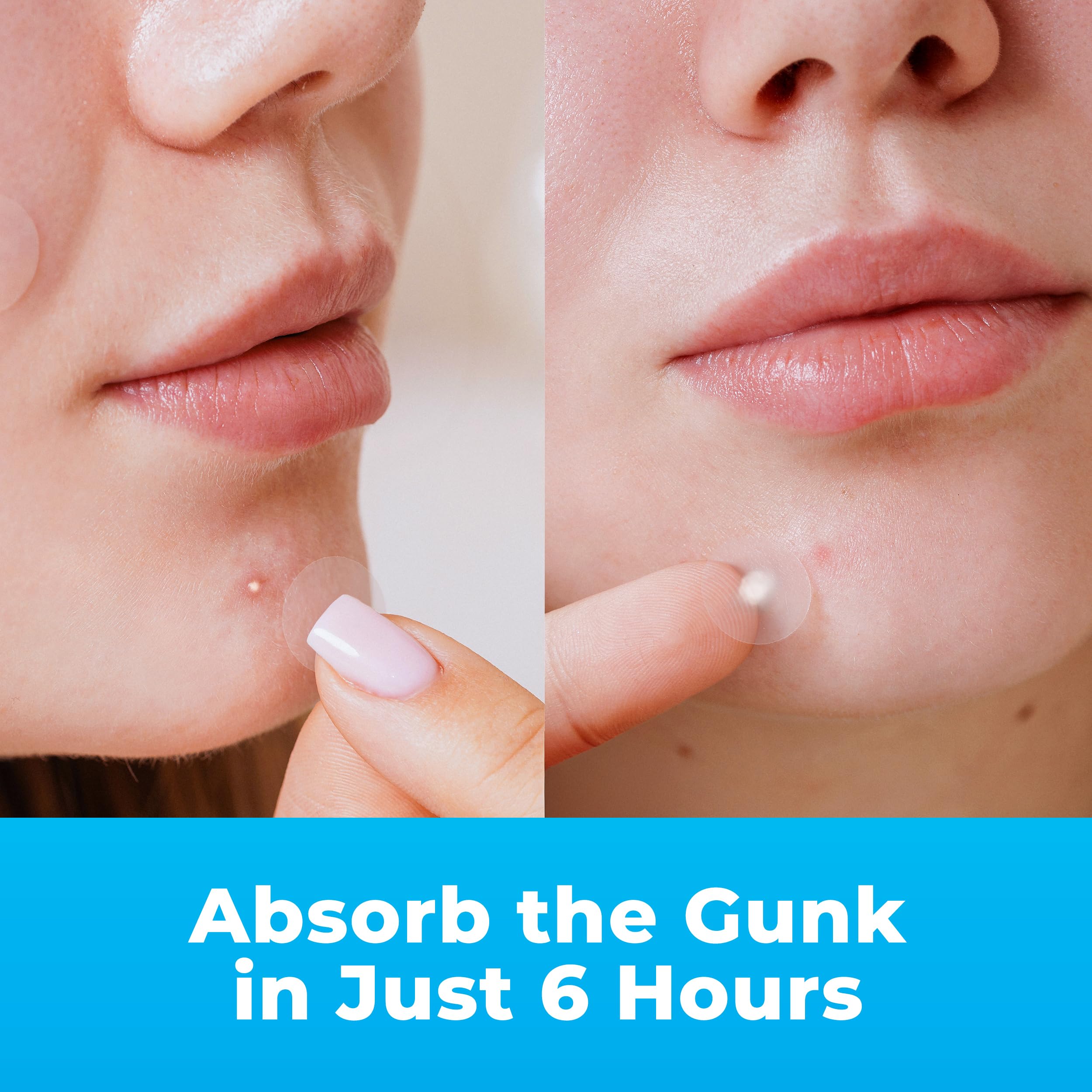 PatchRx acne pimple stickers clear sheet displaying three different sizes of hydrocolloid dots for versatile face coverage