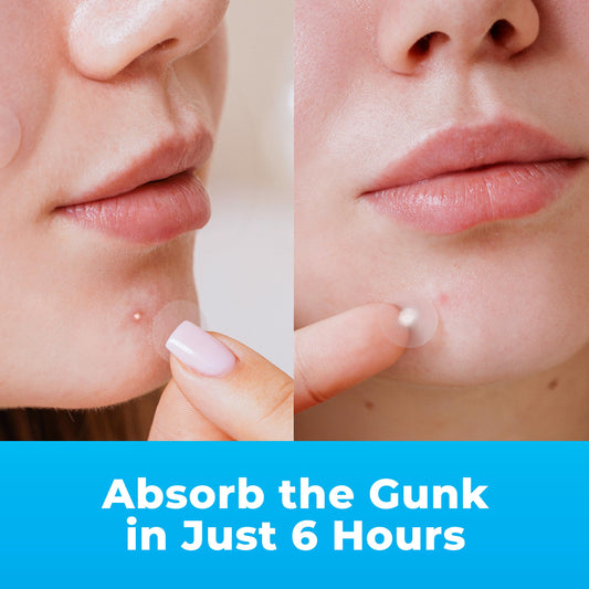 PatchRx acne pimple stickers clear sheet displaying three different sizes of hydrocolloid dots for versatile face coverage