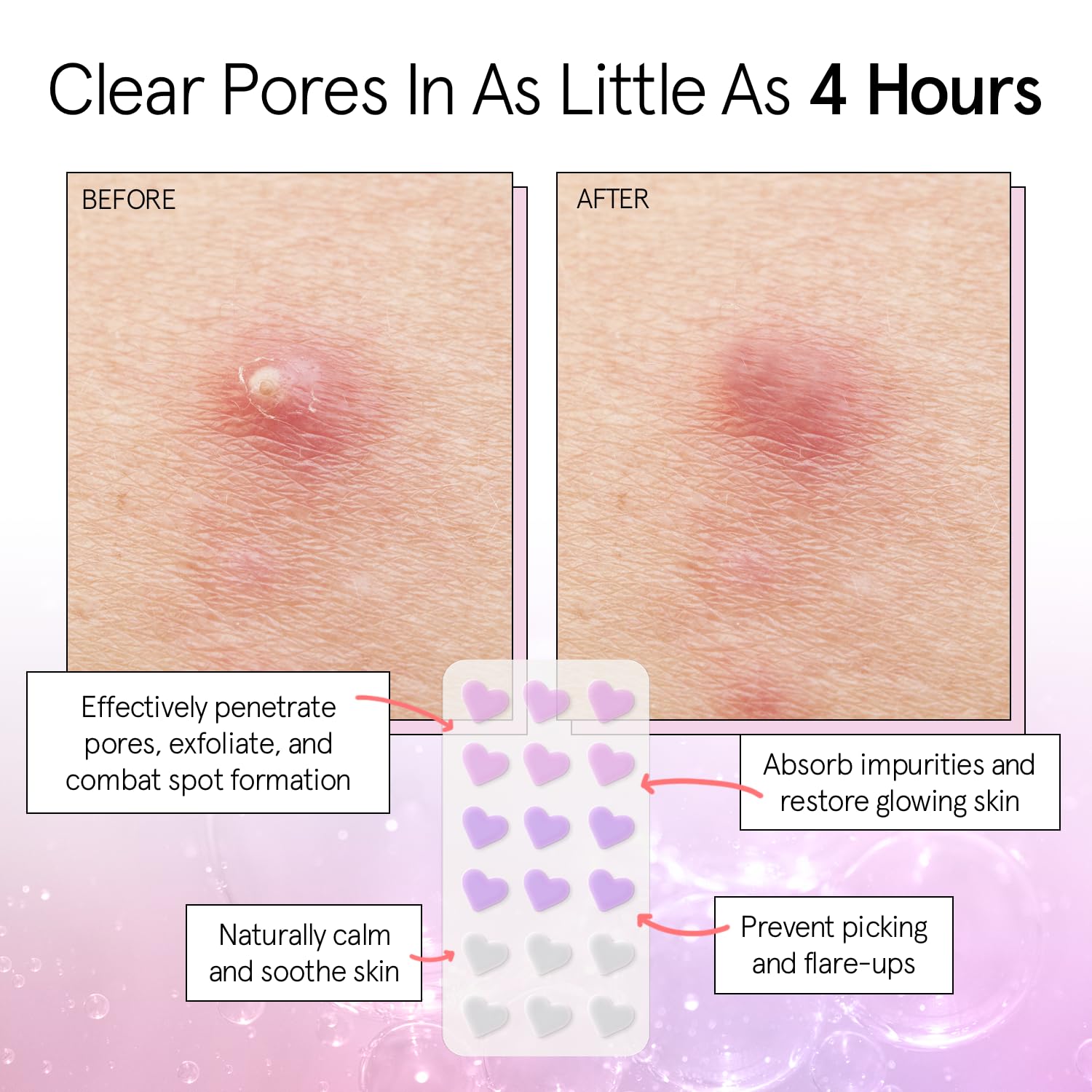Dermatologist tested vegan hydrocolloid spot covers for breakouts.
