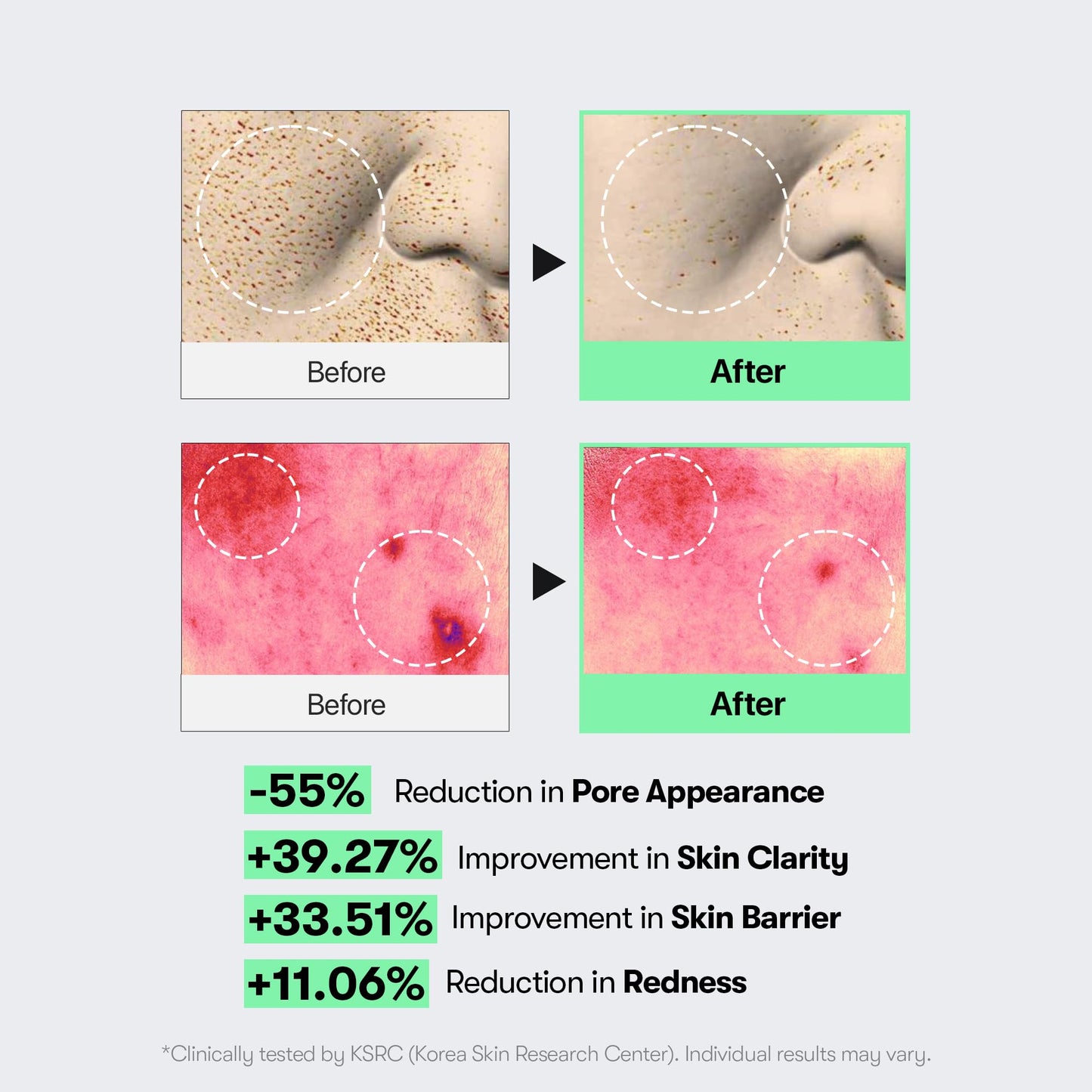 Low intensity microneedling daily exfoliating serum for skin texture improvement