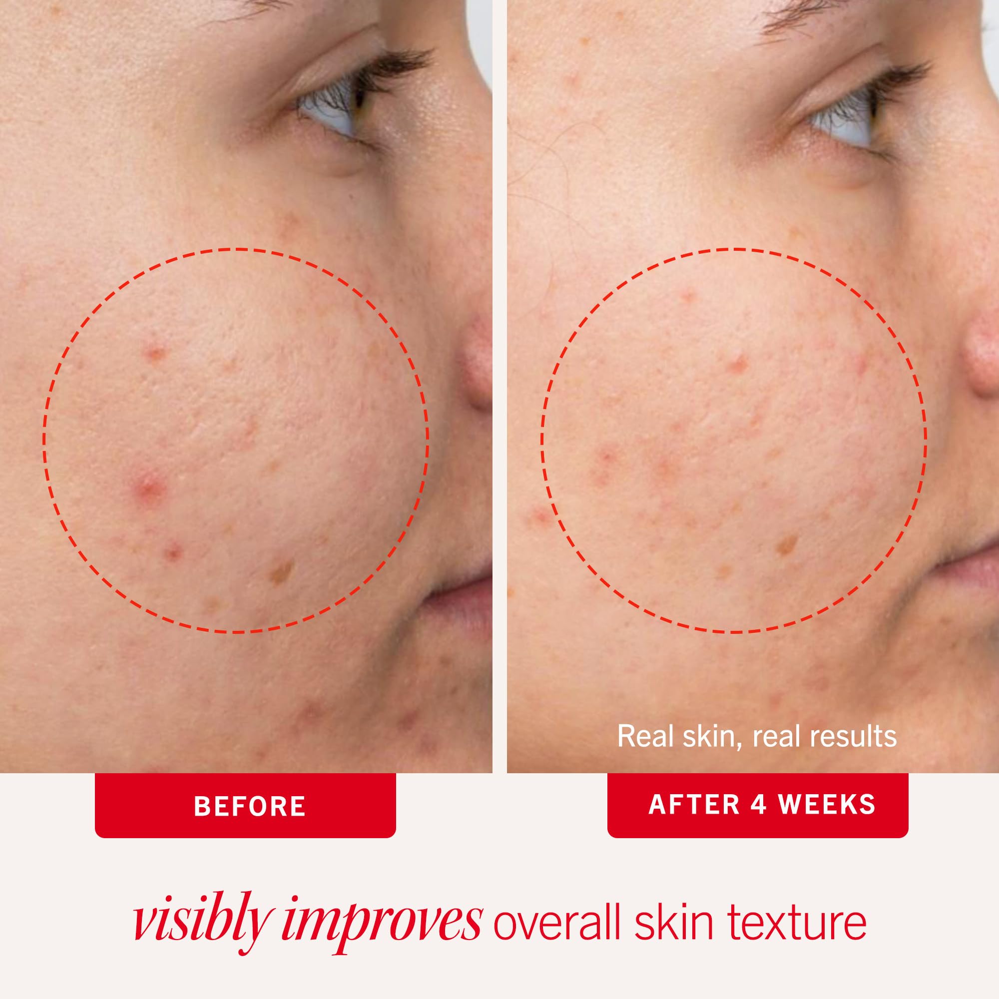 First Aid Beauty maximum strength acne clearing pads packaging detail