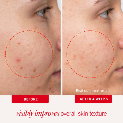 First Aid Beauty maximum strength acne clearing pads packaging detail