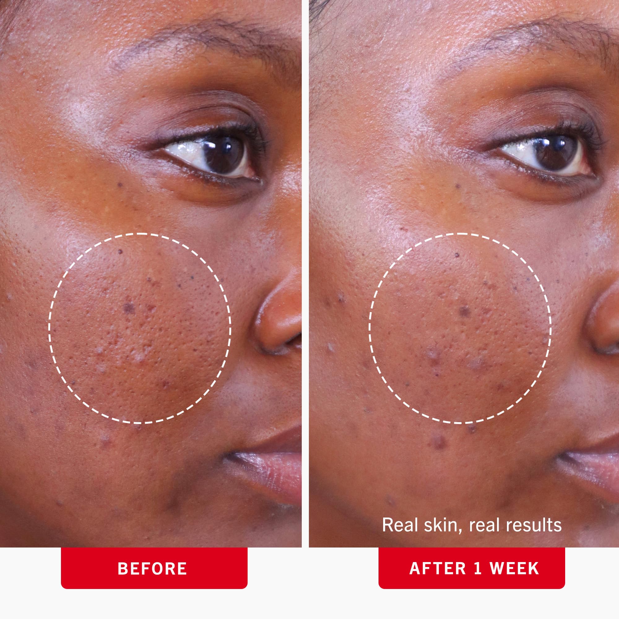 First Aid Beauty dual-sided acne treatment pads texture close up