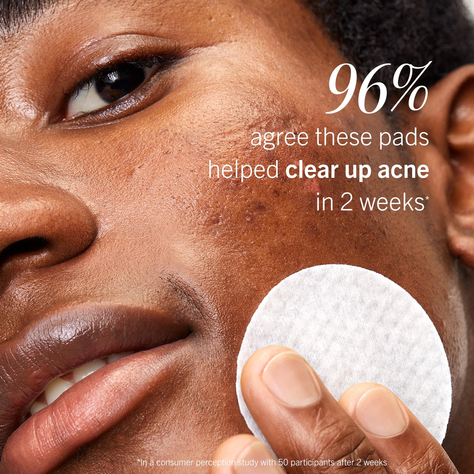 First Aid Beauty imported USA skincare acne treatment pads