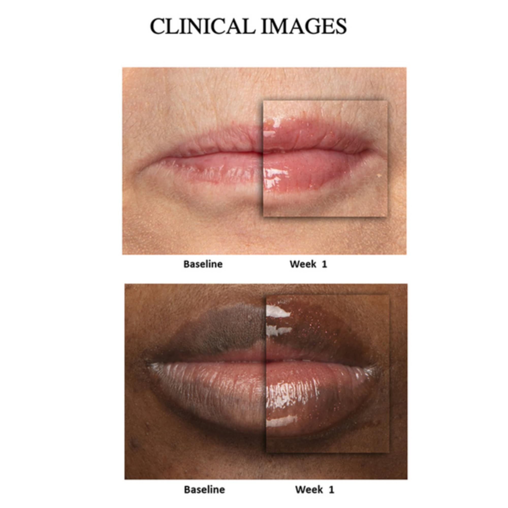 Model showing plumped lips using Nu Skin peptide treatment