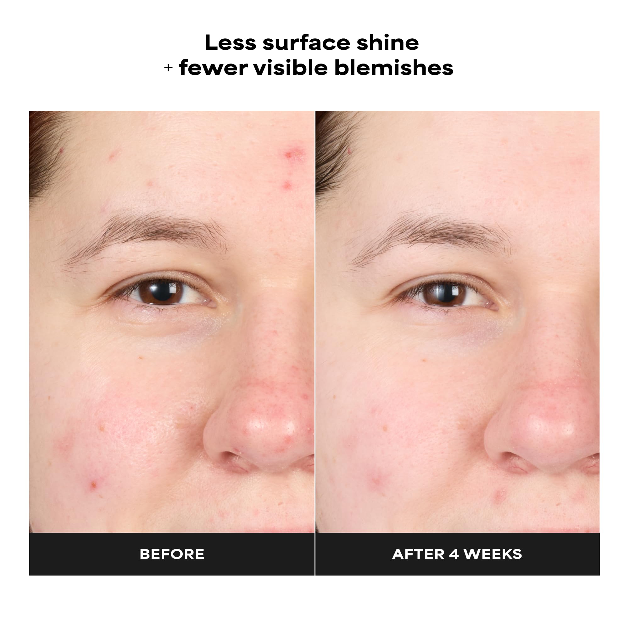 Paula's Choice 1 percent salicylic acid liquid exfoliant for sensitive skin redness care