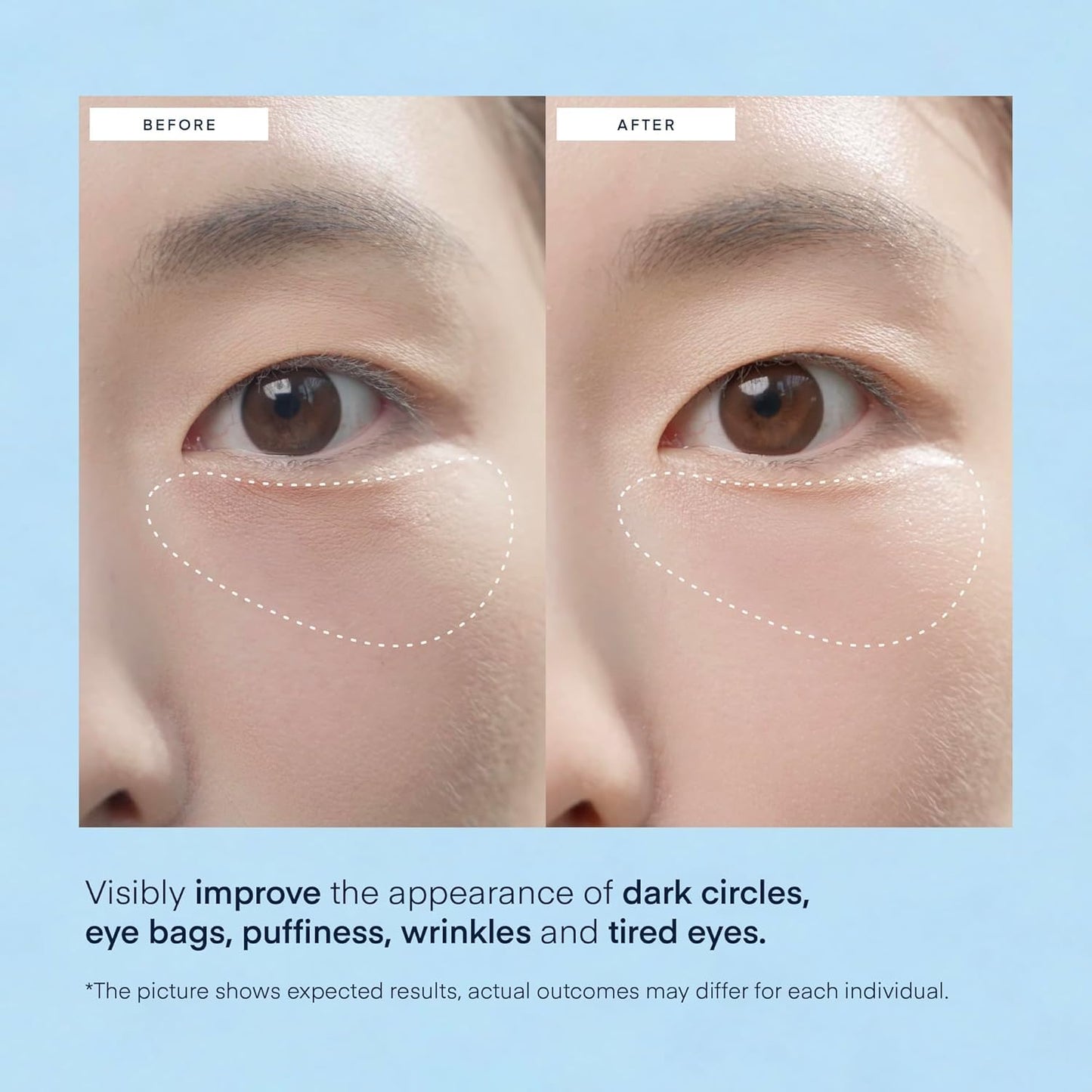 Model applying the hyaluronic acid under eye mask for targeted puffiness reduction
