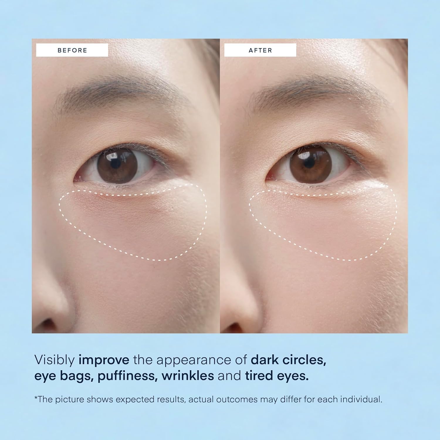 Model applying the hyaluronic acid under eye mask for targeted puffiness reduction