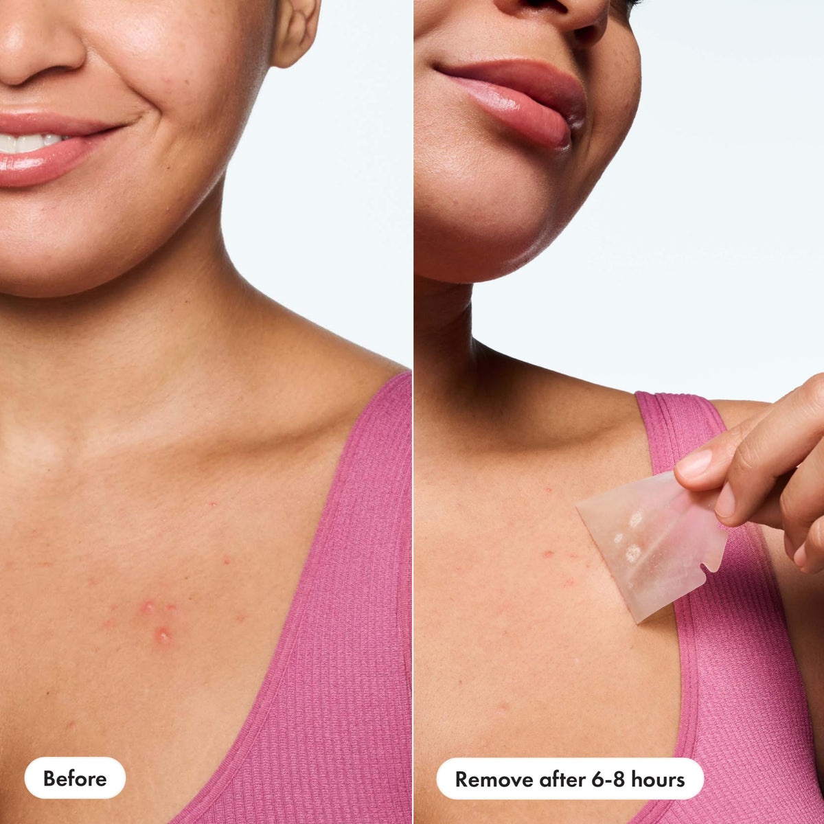 Hero Cosmetics Mighty Patch Body demonstrated on back and shoulders
