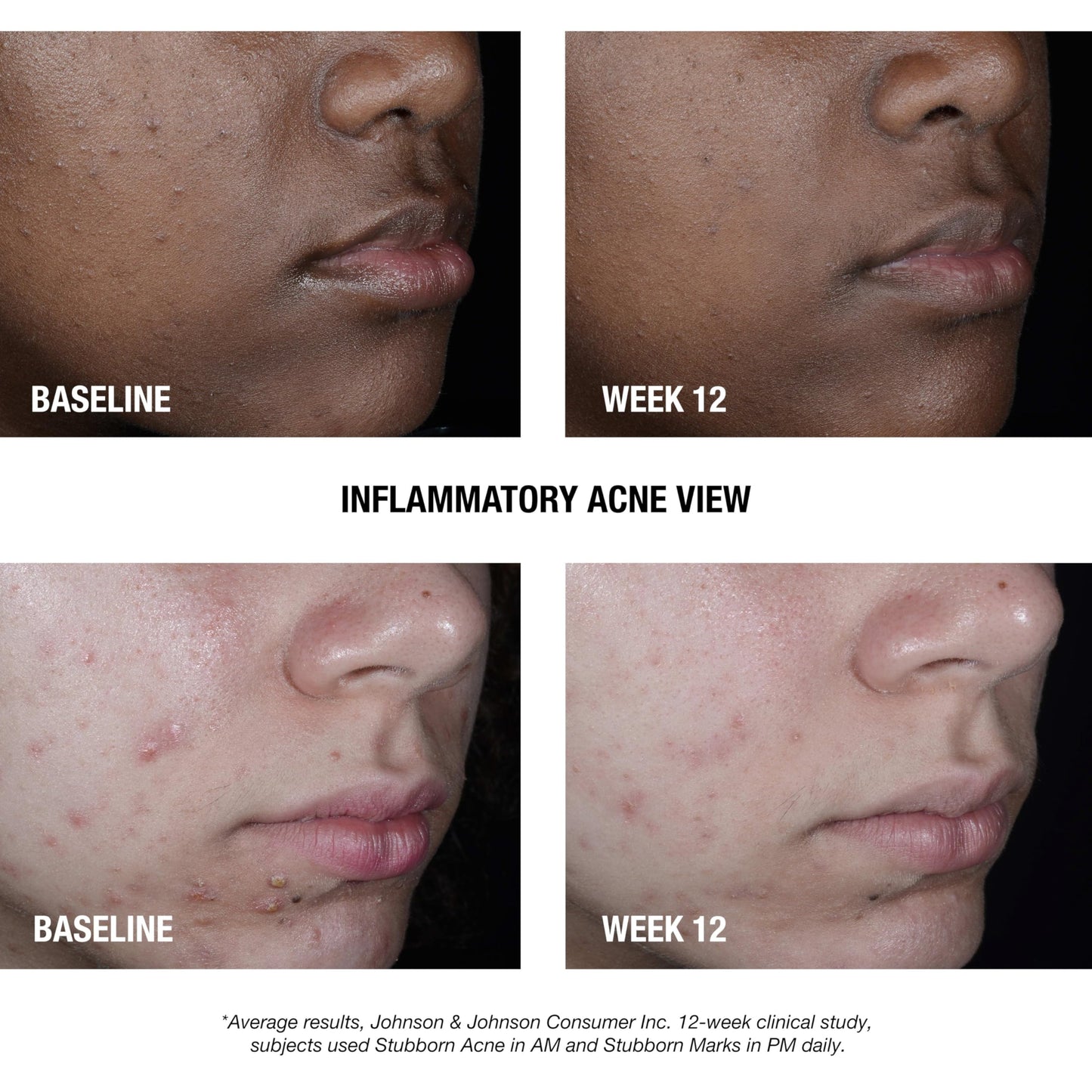 Back of the Neutrogena Stubborn Acne AM Treatment packaging detailing the drug facts, active ingredients, and daily application instructions.