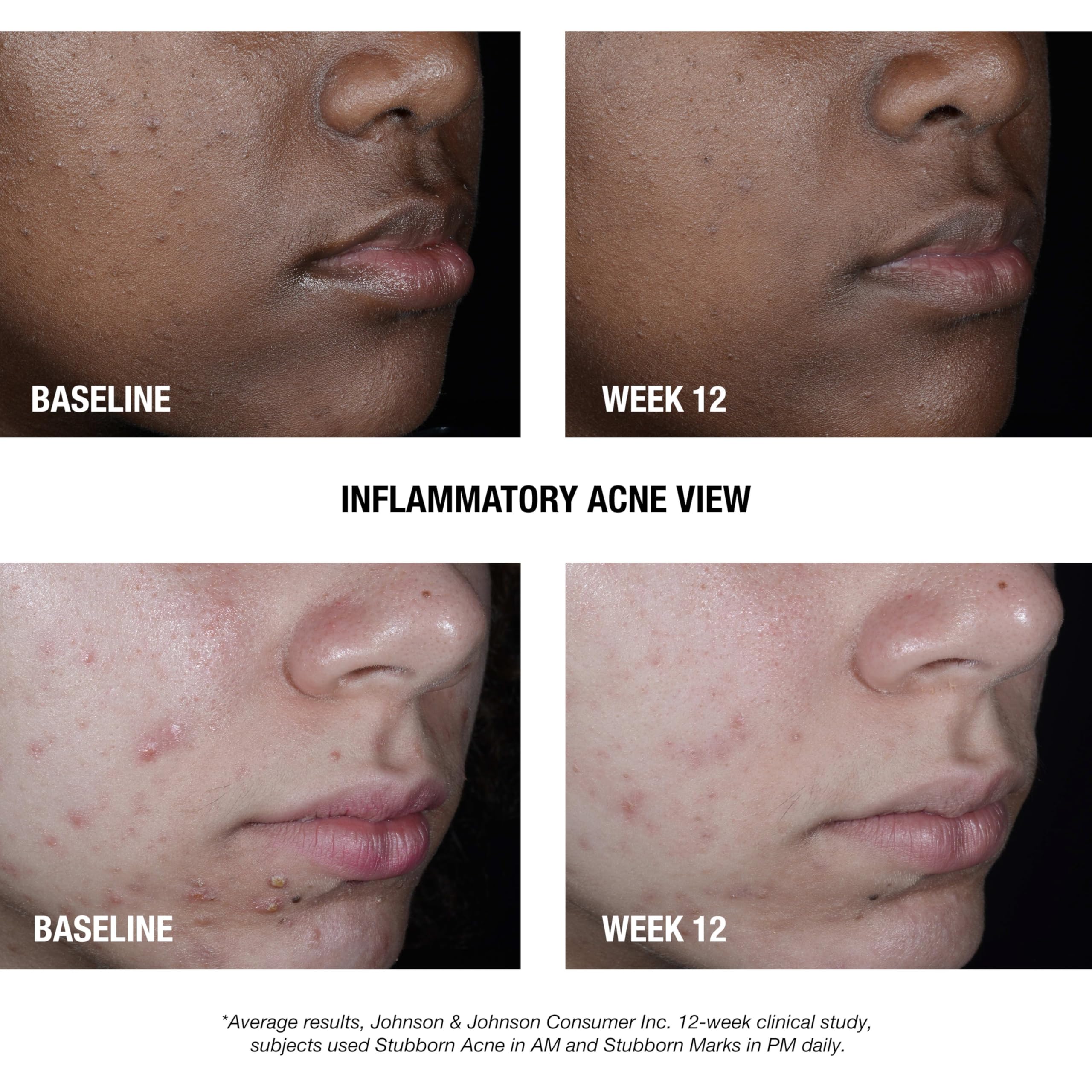 Back of the Neutrogena Stubborn Acne AM Treatment packaging detailing the drug facts, active ingredients, and daily application instructions.
