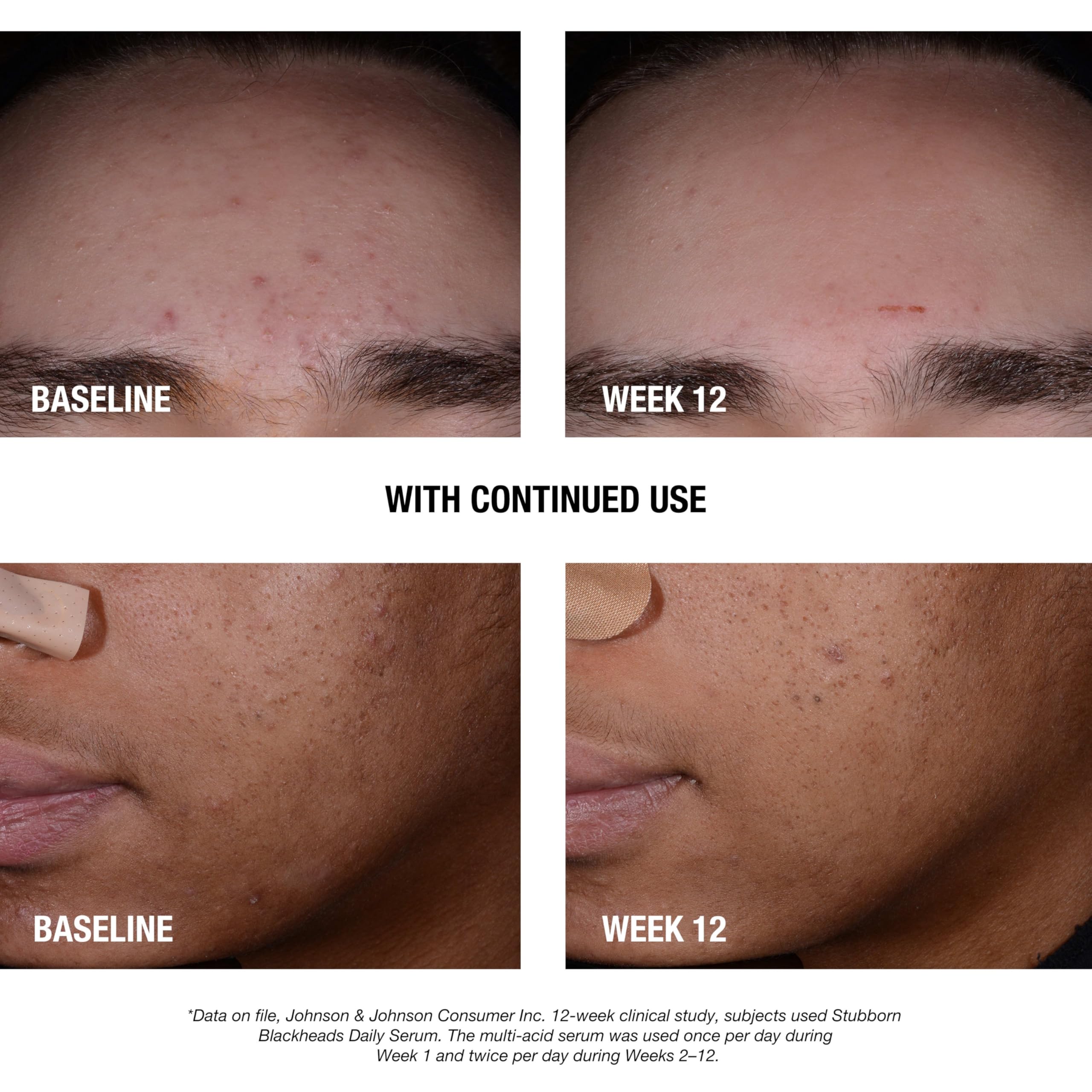 Neutrogena salicylic acid and glycolic acid exfoliating serum clear liquid texture