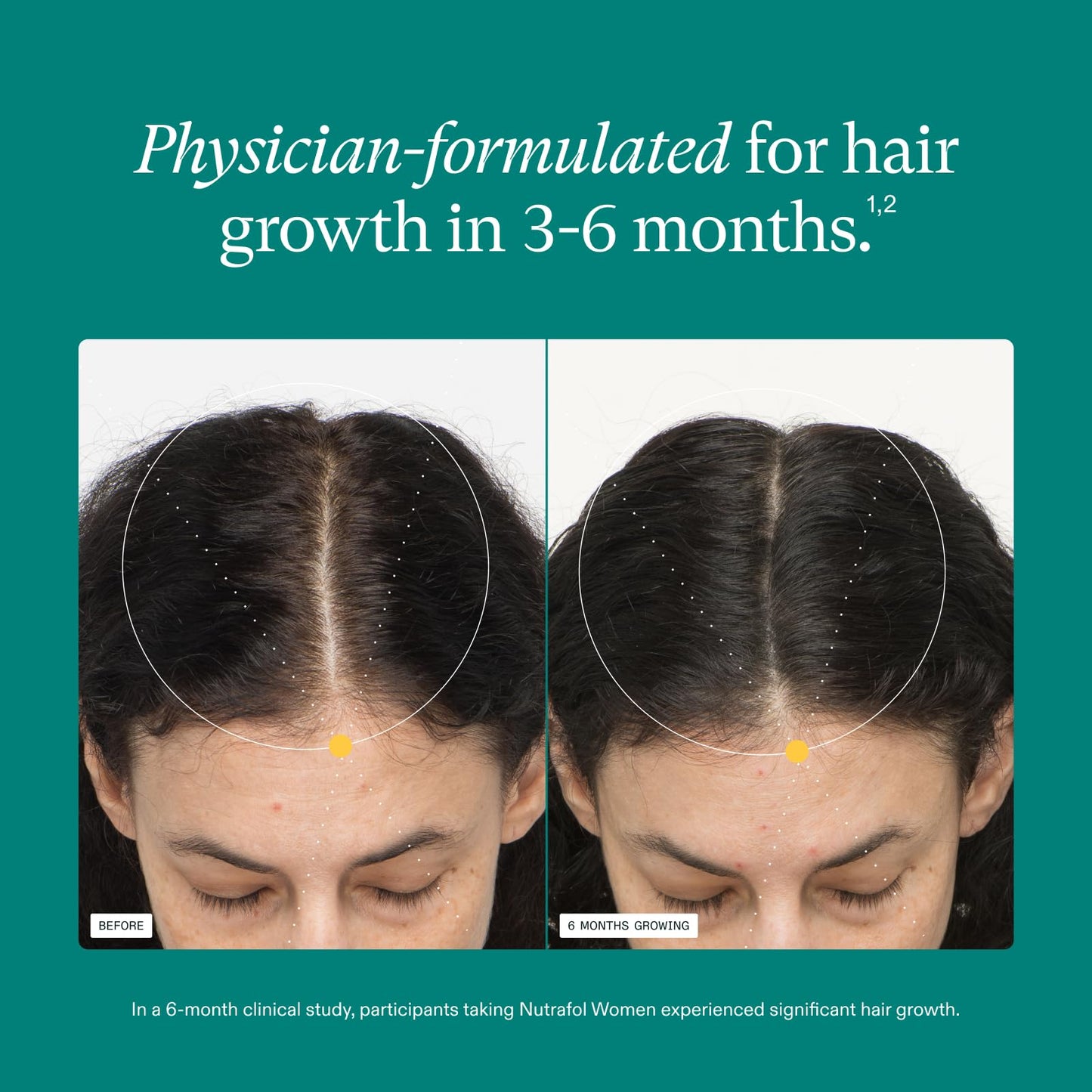 Nutrafol Synergen Complex hair wellness nutraceutical capsules for combating hair thinning