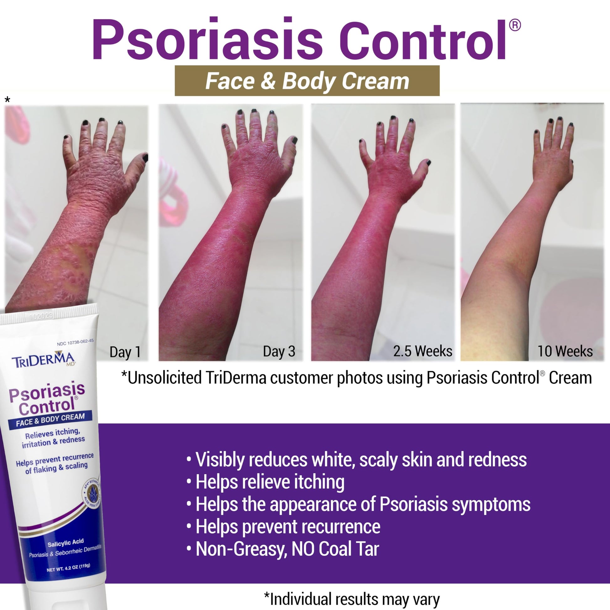 TriDerma intensive moisturizing psoriasis treatment tube side view