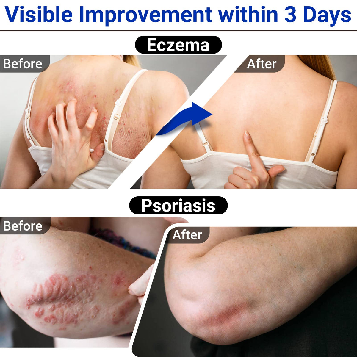 Steroid free eczema relief cream by LMNOOP for sensitive skin application.