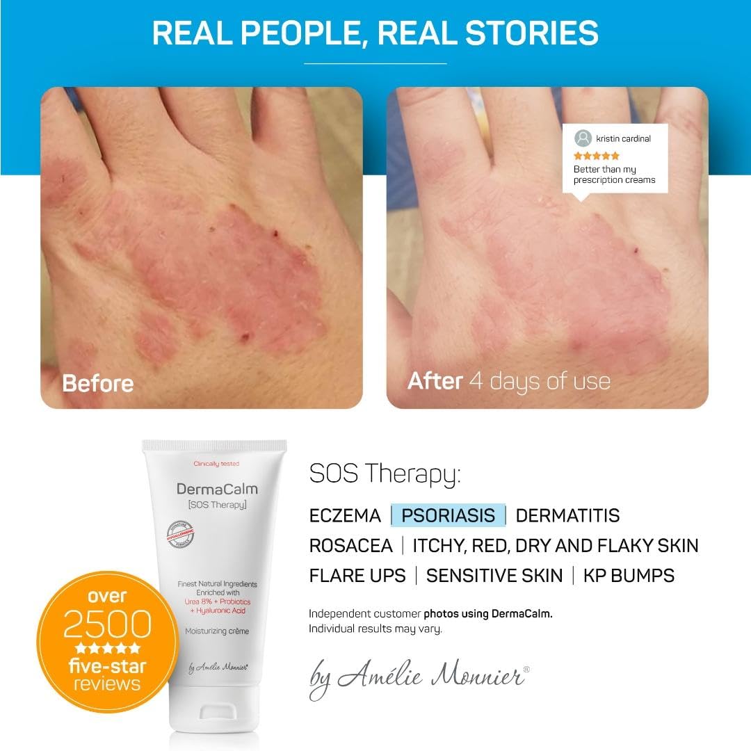 Steroid free eczema cream with 8 percent urea and probiotics packaging
