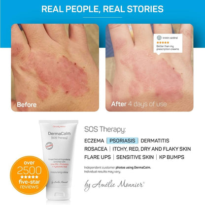 Steroid free eczema cream with 8 percent urea and probiotics packaging