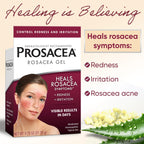 Prosacea multi symptom homeopathic sulphur treatment gel for pimples