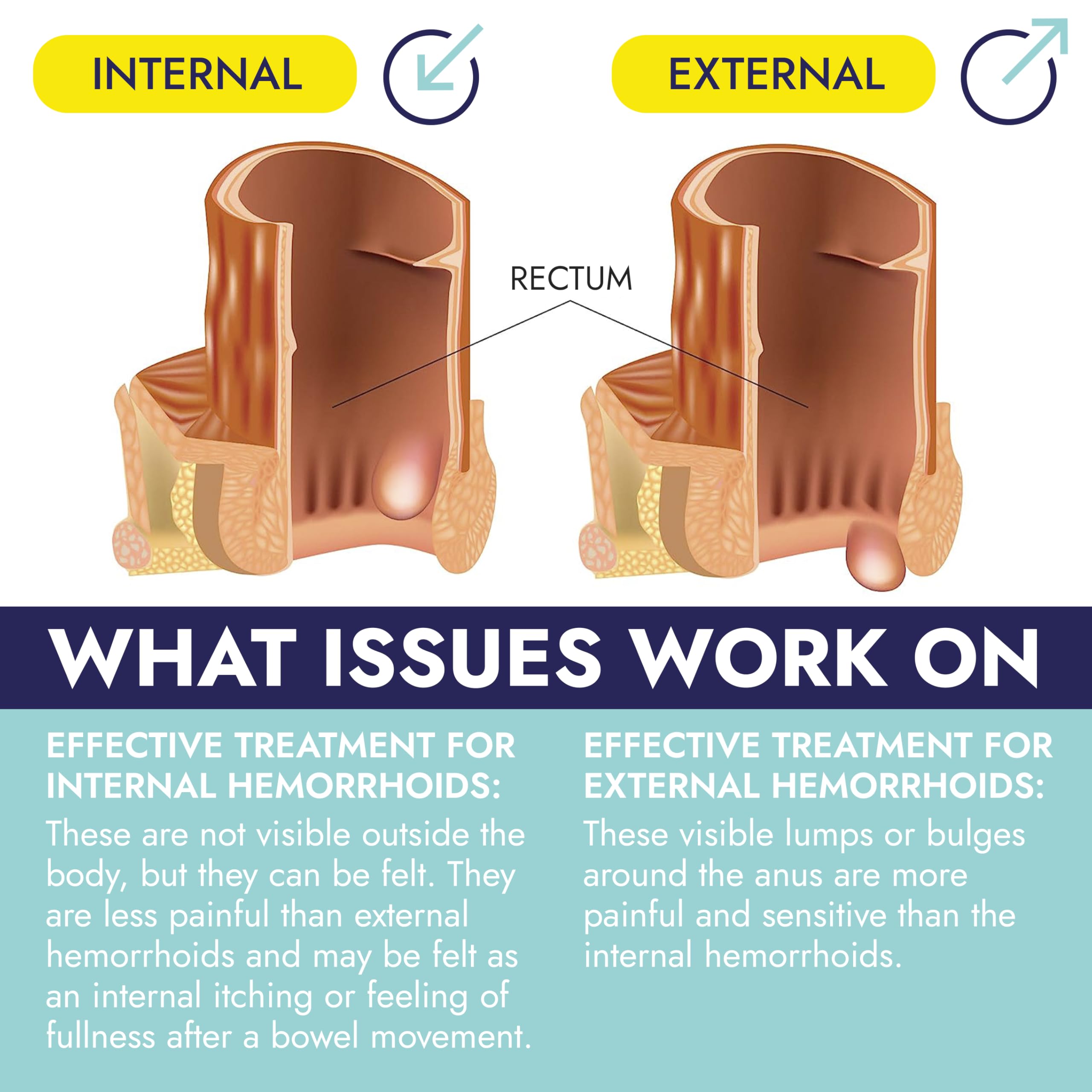 Hygienic pre-filled applicator for Terramed fissure ointment demonstrating mess-free usage design.