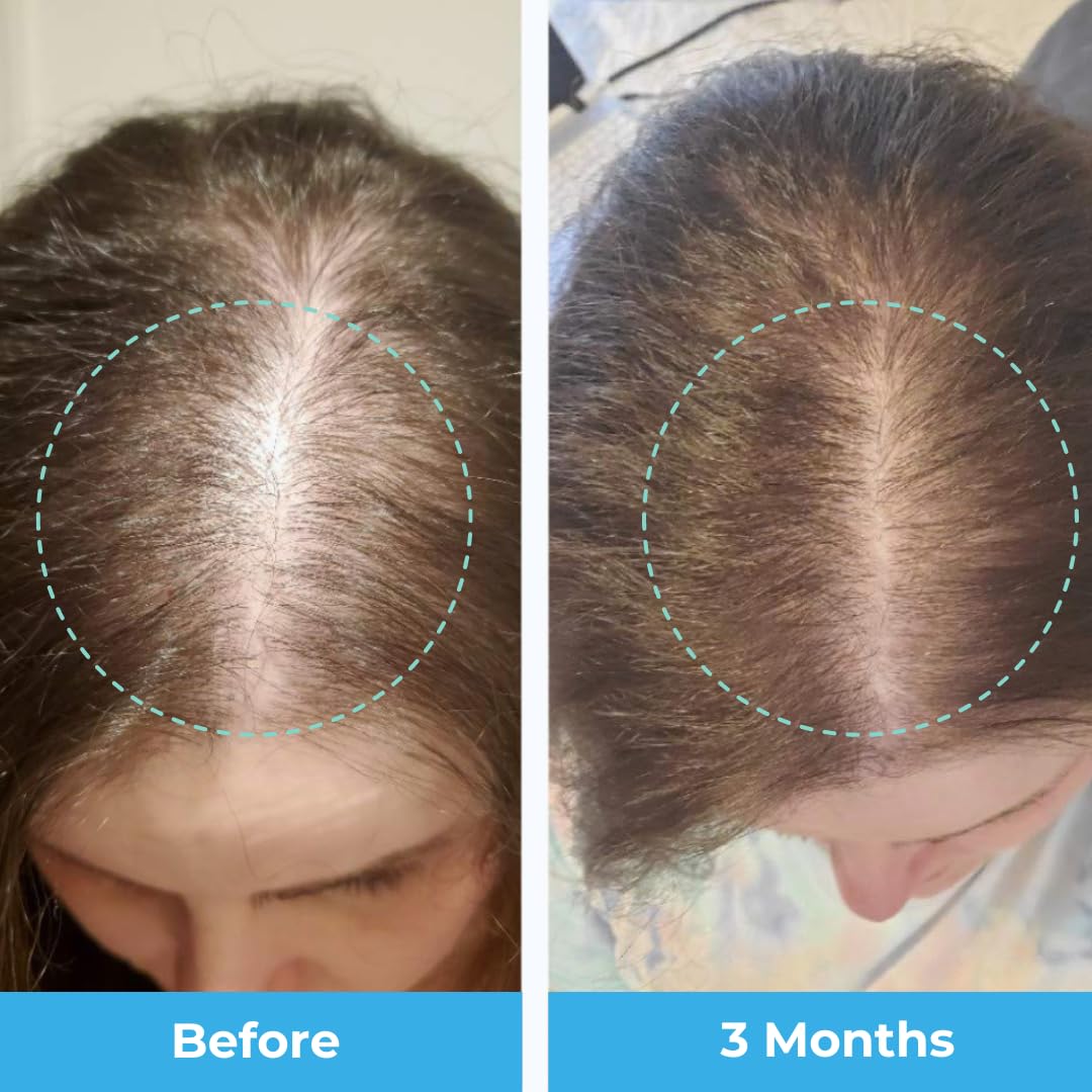 Baby Blues premium hair growth gummies packaging highlighting iron free formulation