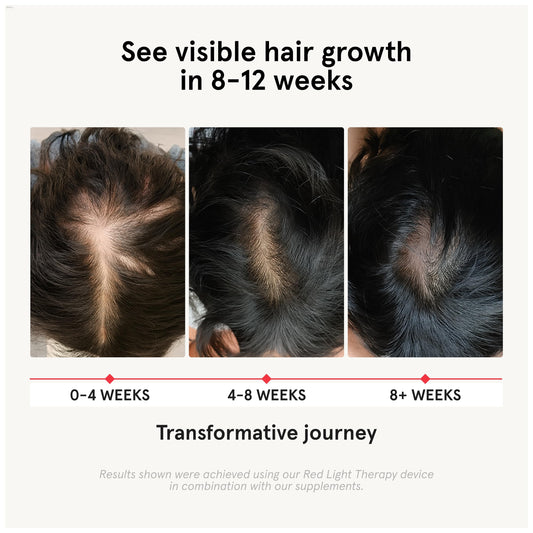 iRestore hair loss vitamins packaging showing high potency biotin and natural DHT blockers label