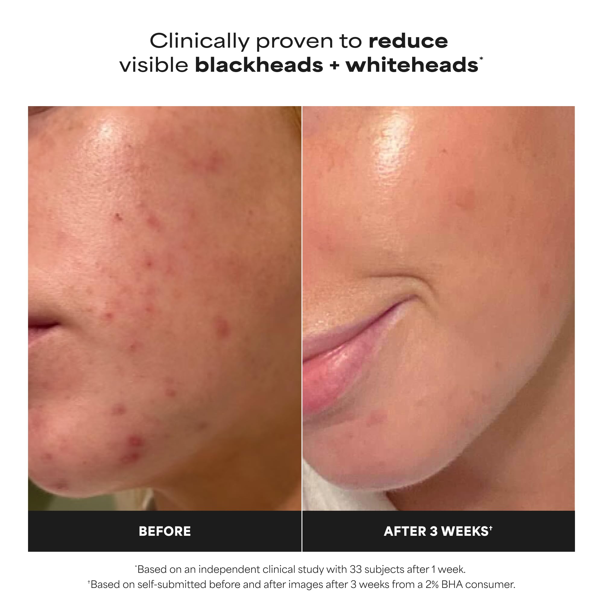 Paula's Choice Salicylic Acid leave on exfoliant bottle for blackhead reduction
