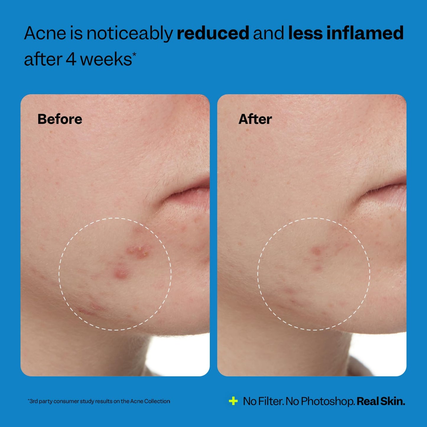 Authentic imported USA skincare toner for clearing breakouts and blackheads