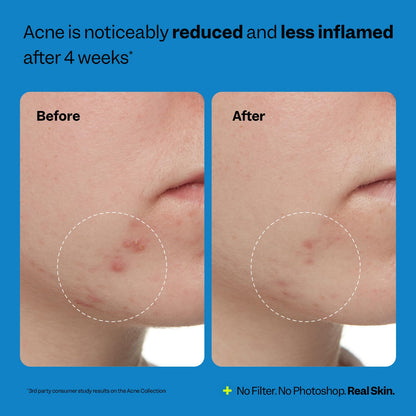 Authentic imported USA skincare toner for clearing breakouts and blackheads