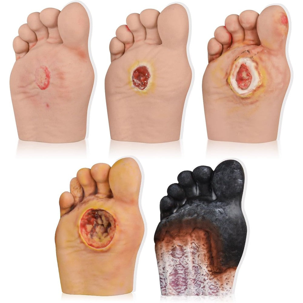 Ultrassist 5 Piece Diabetic Foot Care Model set showing grades 1 to 5 for medical training.